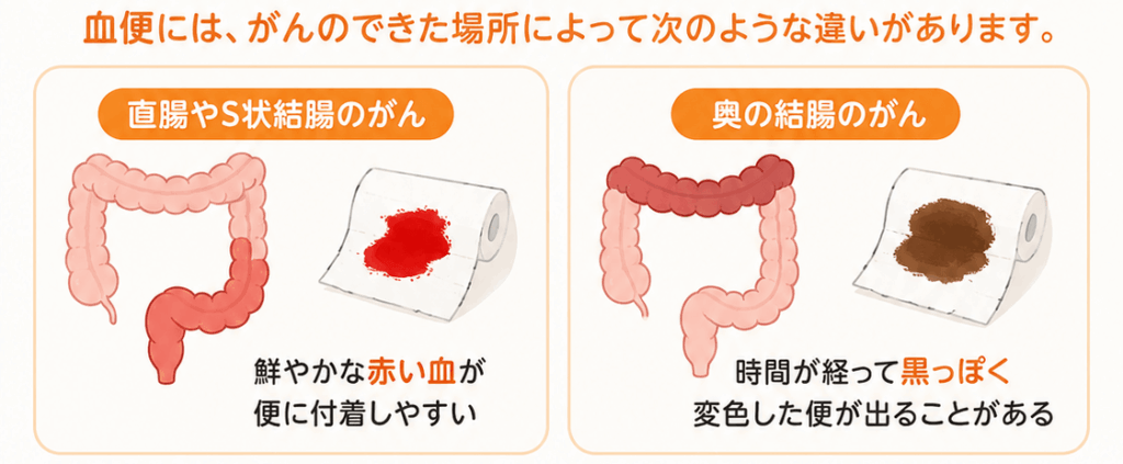 便に血が混じる・黒い便が出る(血便)