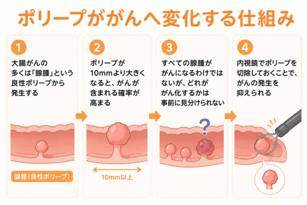 大腸ポリープが大腸がんへと変化する仕組み