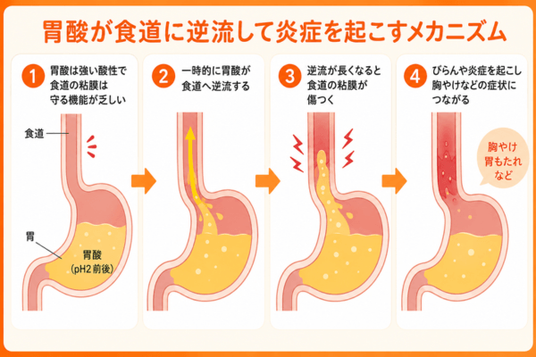 胃酸が食道に逆流して炎症を起こすメカニズム