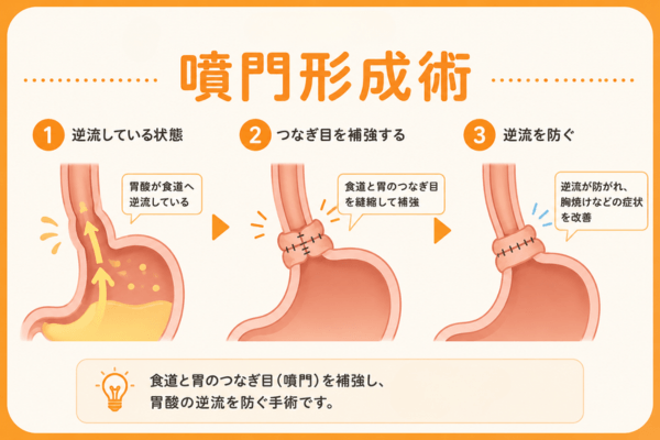 噴門形成術