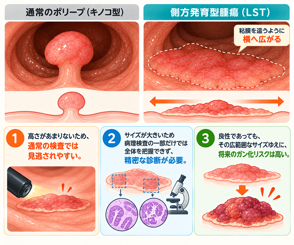 良性と悪性の中間に位置する側方発育型腫瘍（LST）とは