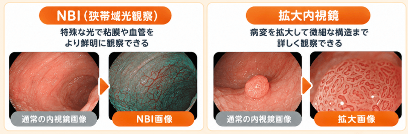 最新の内視鏡技術（NBI・拡大内視鏡）による判別