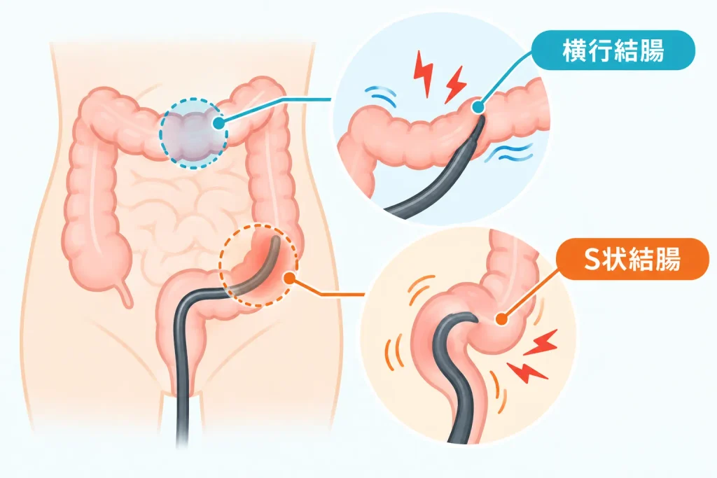 腸が長い・曲がり角が多い人（S状結腸など）