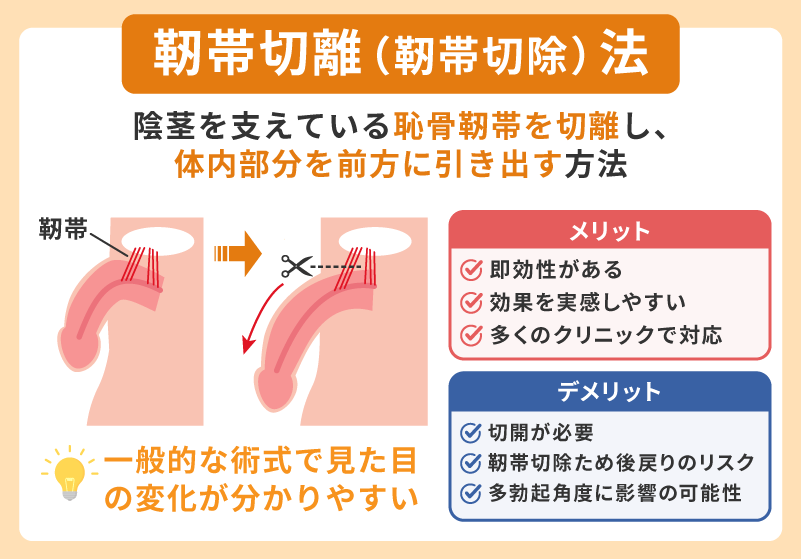 靭帯切離(靭帯切除)法