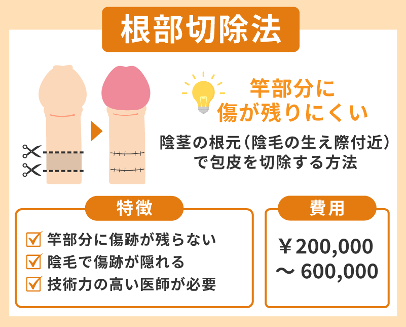 根部切除法は竿部分に傷が残らない